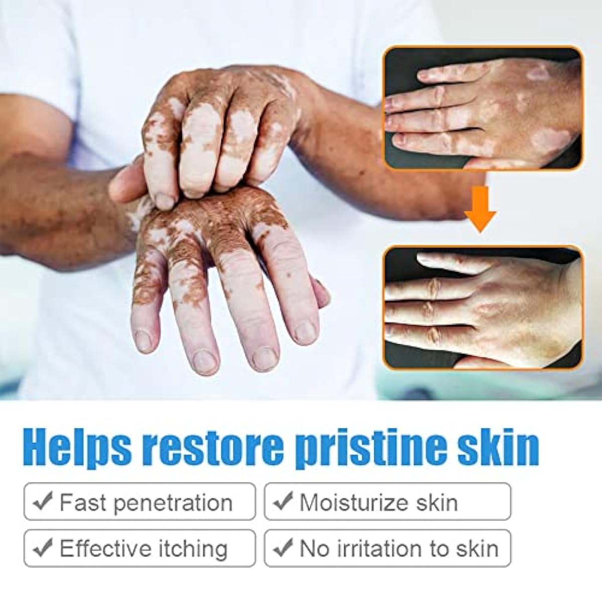 Sumifun Vitiligo Treatment Cream