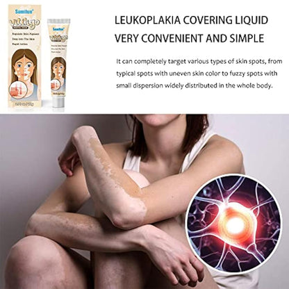 Sumifun Vitiligo Treatment Cream
