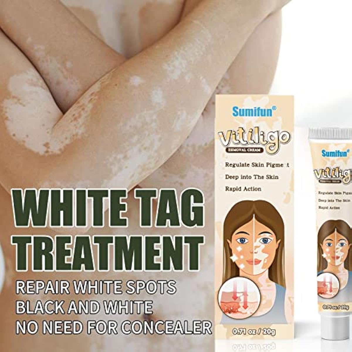 Sumifun Vitiligo Treatment Cream