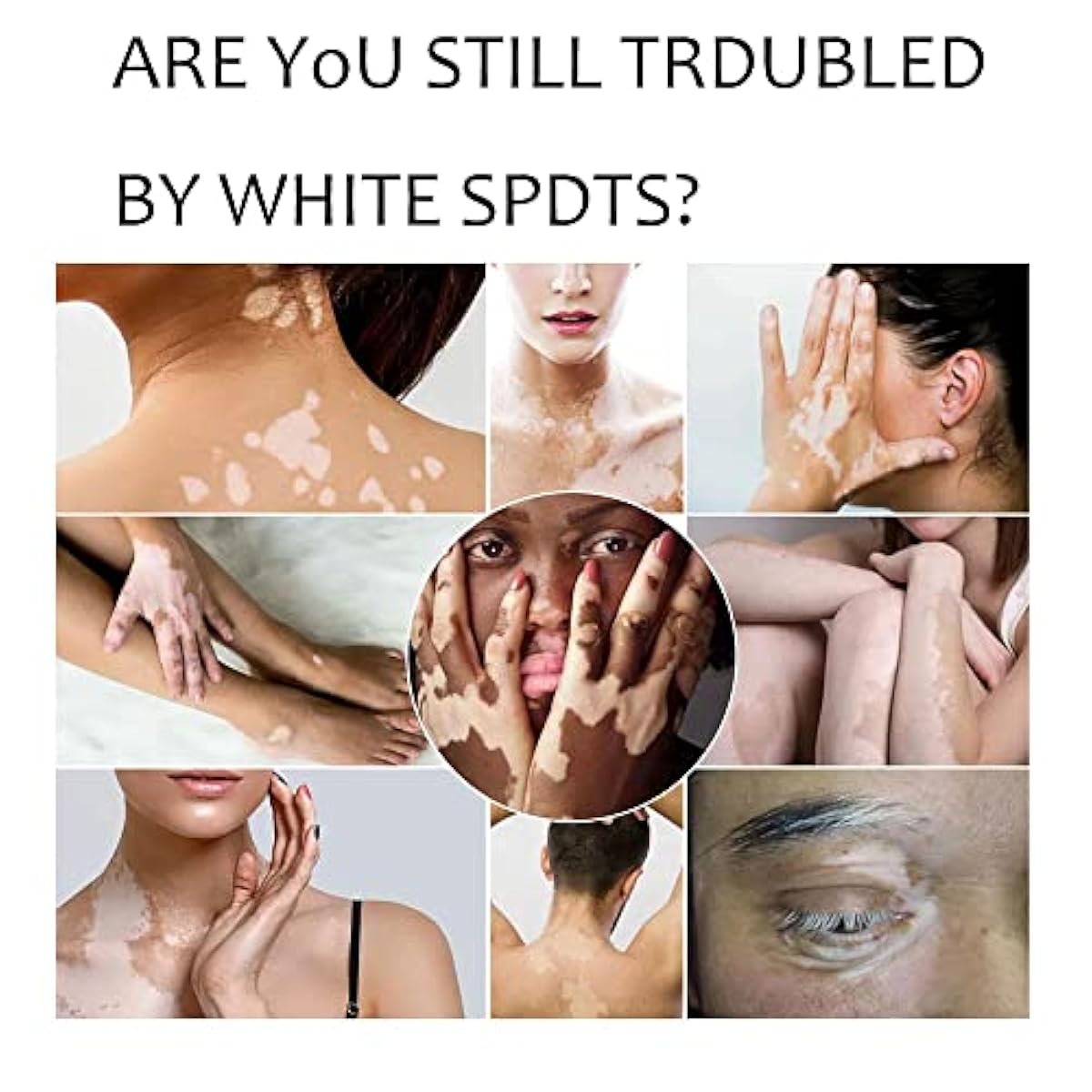 Sumifun Vitiligo Treatment Cream