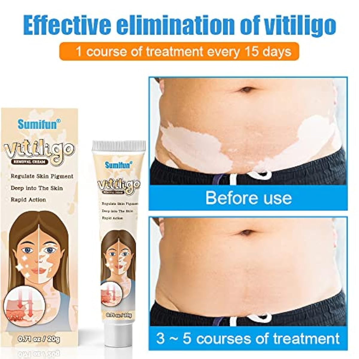 Sumifun Vitiligo Treatment Cream