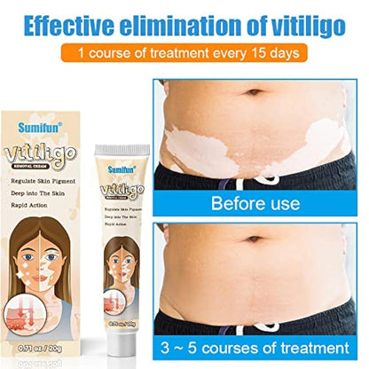 Sumifun Vitiligo Treatment Cream