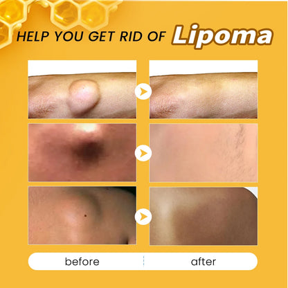 🐝✨ Sumifun Bee Venom Lipoma Cream – Transform Your Skin, Naturally! ✨🐝