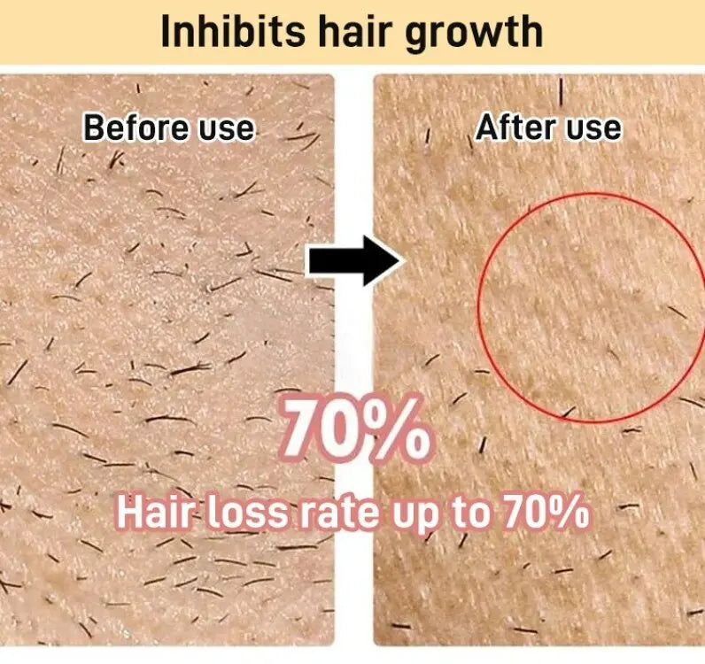 Mini Laser Hair Removal Device